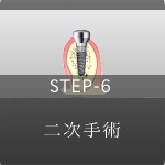 STEP-6 仮歯の装着