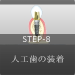 STEP-8 人工歯の装着
